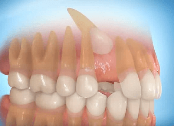 Tooth extraction in Yerevan, Armenia - GDC