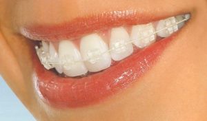 Ceramic braces