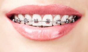 Metal braces