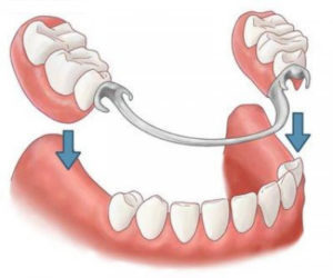 Removable and partially removable dentures