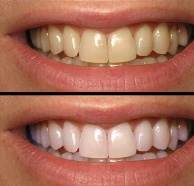 Химическое отбеливание зубов в Ереване, Армении - GDC